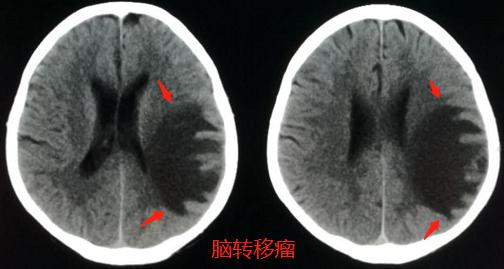 头晕、手麻，不是脑血栓，是肺癌脑转移？豪大夫讲肺结节（三）