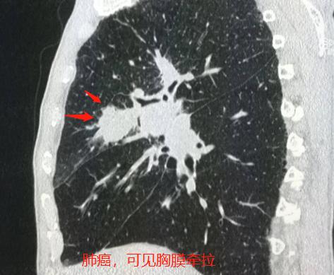 头晕、手麻，不是脑血栓，是肺癌脑转移？豪大夫讲肺结节（三）