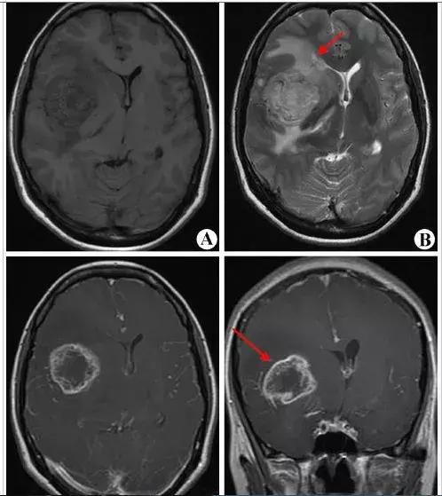 手机打多了容易得脑瘤吗,因手机引发脑瘤