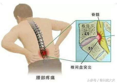 怎么爬行治疗腰间盘膨出,牵引对腰间盘膨出有效吗