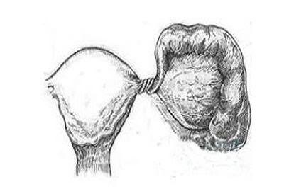 邯郸市中心医院功能科彩超室准确诊断一例儿童卵巢扭转