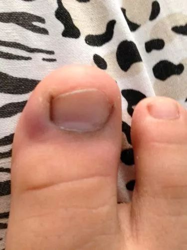 靶向治疗怎么预防副作用,如何防止靶向药伤肾