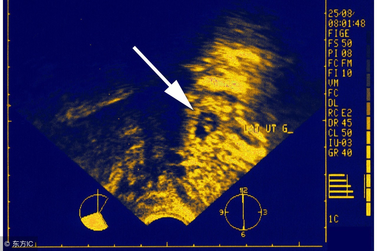 宫外孕引起的原因和男士有关系吗,宫外孕腿好胀好酸是什么原因