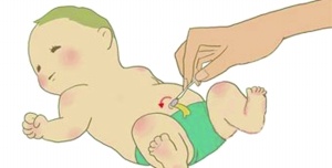 新生儿脐炎一直有黄水流出,新生儿肚脐红肿流水怎么办