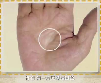 手上的健康秘密,手诊10种常见病从手上就能看出来