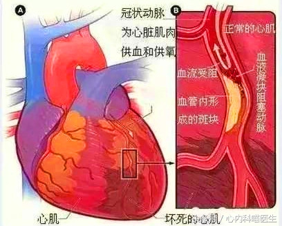 心绞痛需要放入支架吗,心绞痛要不要放支架