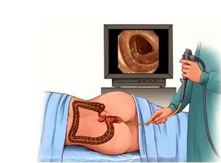 体检发现肠息肉病例,年轻女性查出肠息肉