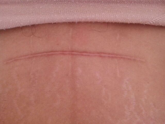 剖宫产腹部伤口护理要点,剖宫产术后腹部伤口感染