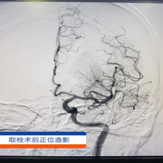 兰州石化总医院卒中中心成功救治一名昏迷脑卒中患者