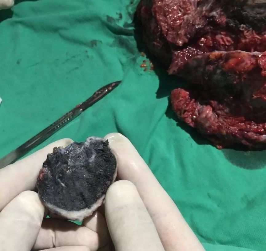 尘肺病的悲惨命运,尘肺病之殇图文