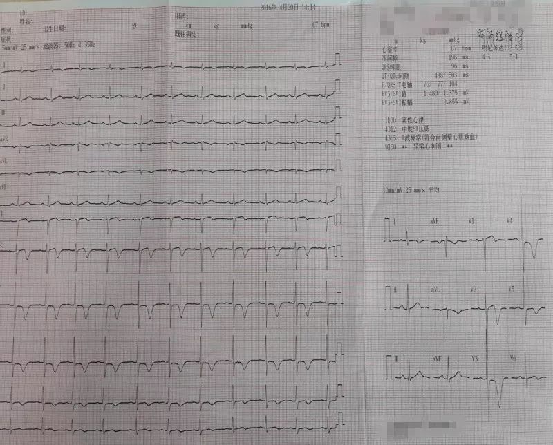 发作性胸痛心电图正常,心电图轻度T波改变图片