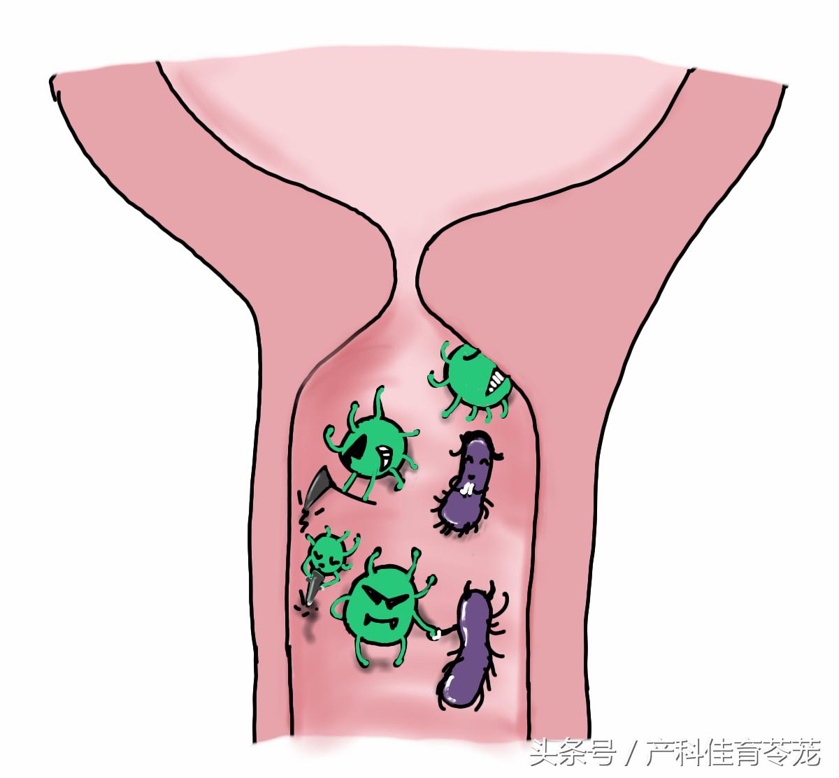 解脲支原体感染如何治疗,肺炎支原体感染治疗方案