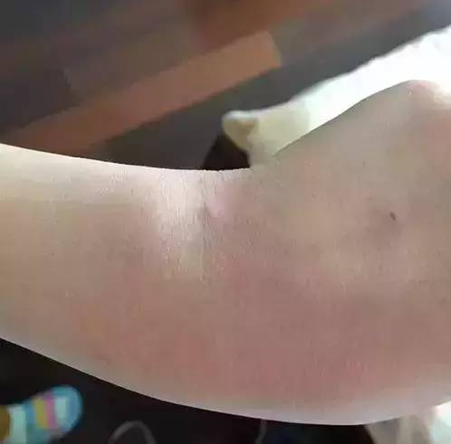 怎么区分水痘与手足口病,疱疹性咽峡炎和手足口病如何分别