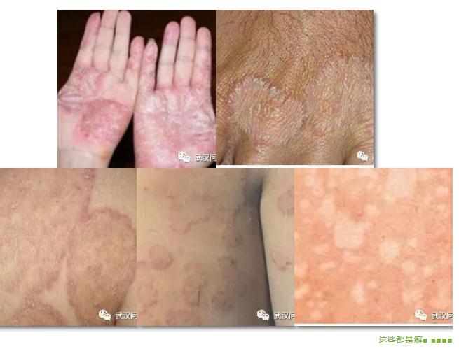 夏天来了脱皮,夏天会变成油皮吗