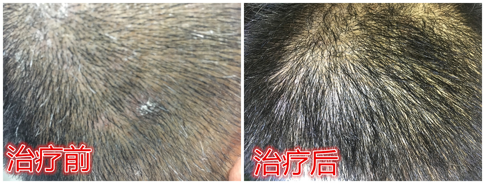 头皮屑过多的中医疗法