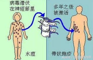 带状疱疹一穿衣服就疼,痛到不能穿衣的带状疱疹怎么治