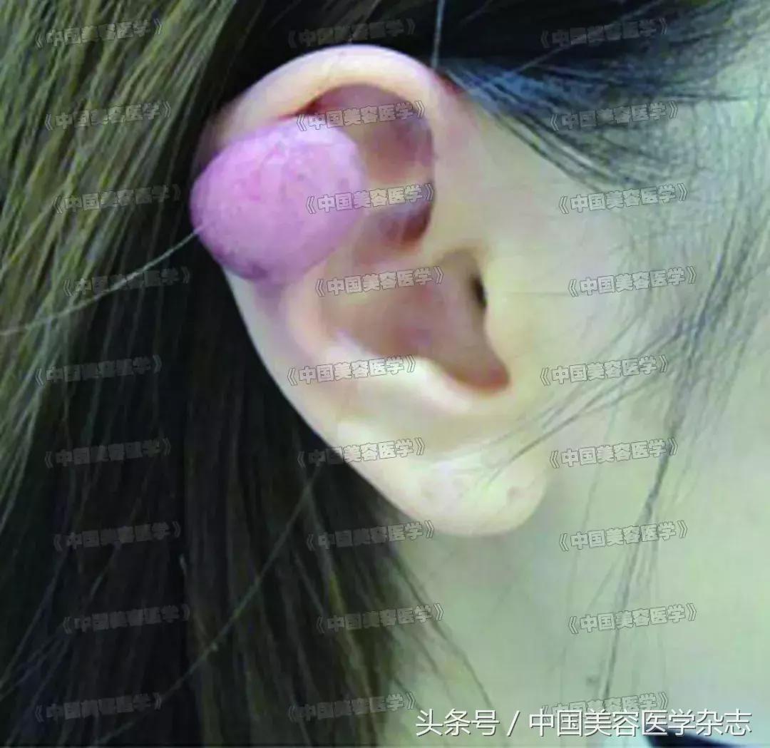 手术联合放疗治疗瘢痕疙瘩,耳廓瘢痕疙瘩切除手术后耳朵化脓