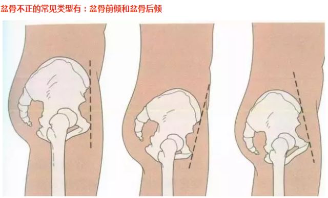 如何判断骨盆后倾还是骨盆前倾,骨盆前倾的日常原因