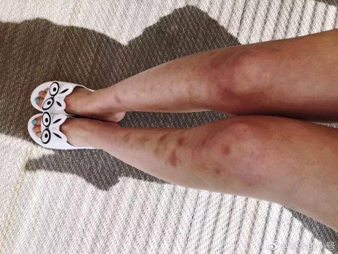 林允暴瘦照片,林允腿上的淤青原因