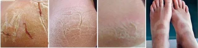 擦掉一张皮，双脚换皮术！死皮、老茧一喷就没，15秒还原嫩白玉足！