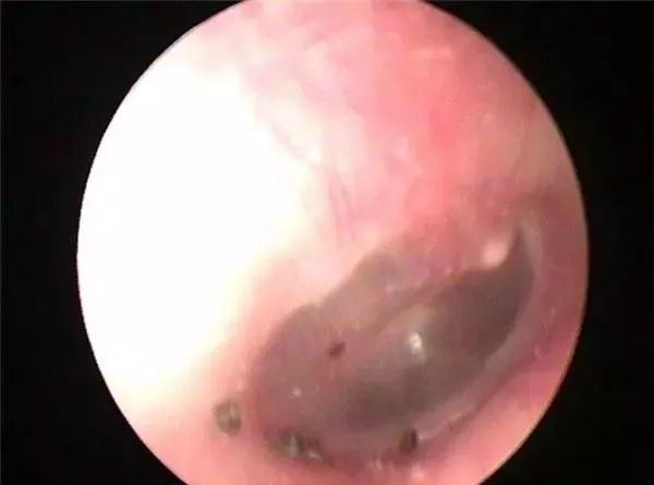 常德女子突然头晕头痛还耳鸣，竟然是这种生物在耳内“安家”了！