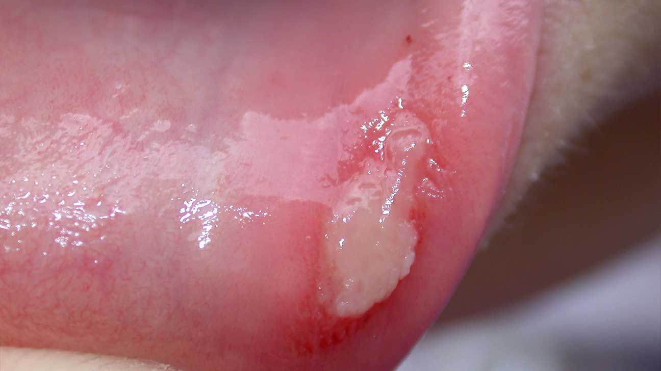 口腔、眼睑、阴道反复溃疡，你可能患上了白塞氏病