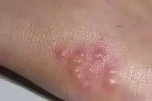 一到夏天脚上总起水泡,一到夏天脚上就长水泡是湿气重么