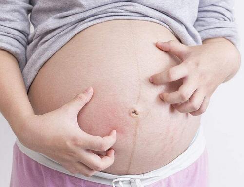 孕晚期肚皮痒长妊娠纹怎么缓解,孕晚期肚皮发痒起痘