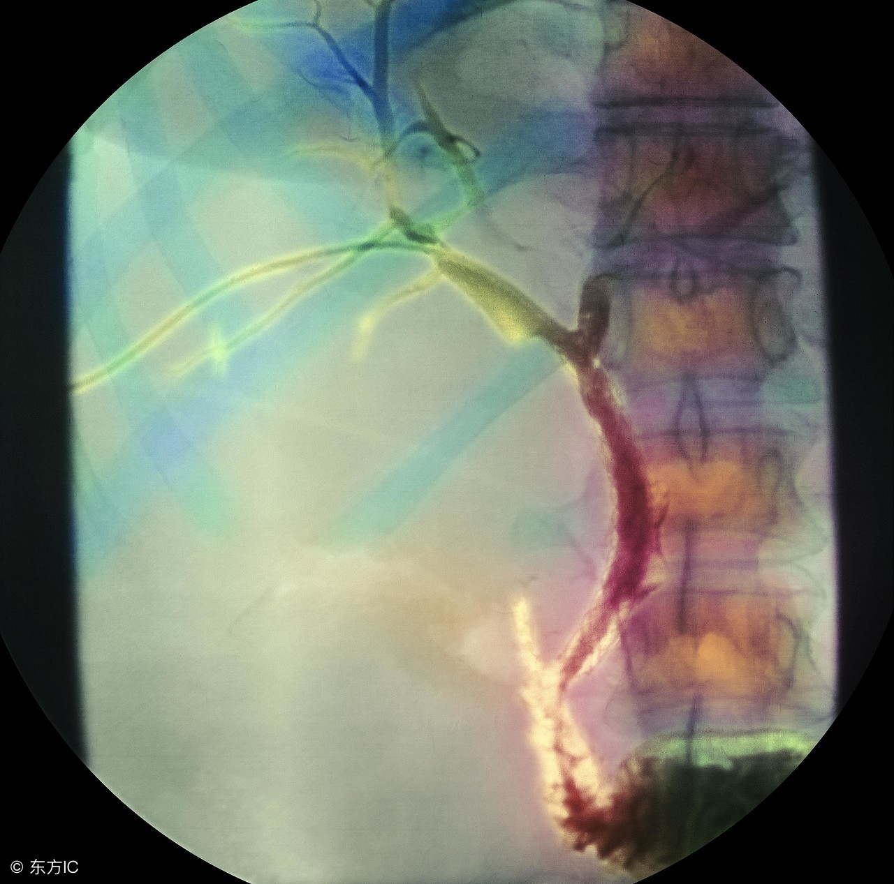 肝门部胆管癌最新治疗方法,胆管癌最好的治疗方法