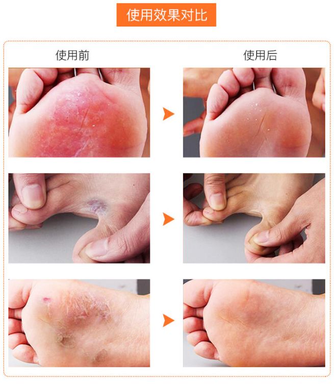 脚气脚臭有救了！有了这块韩国嫩足皂，轻轻一洗，杀菌治脚气，告别瘙痒，连死皮都不见了