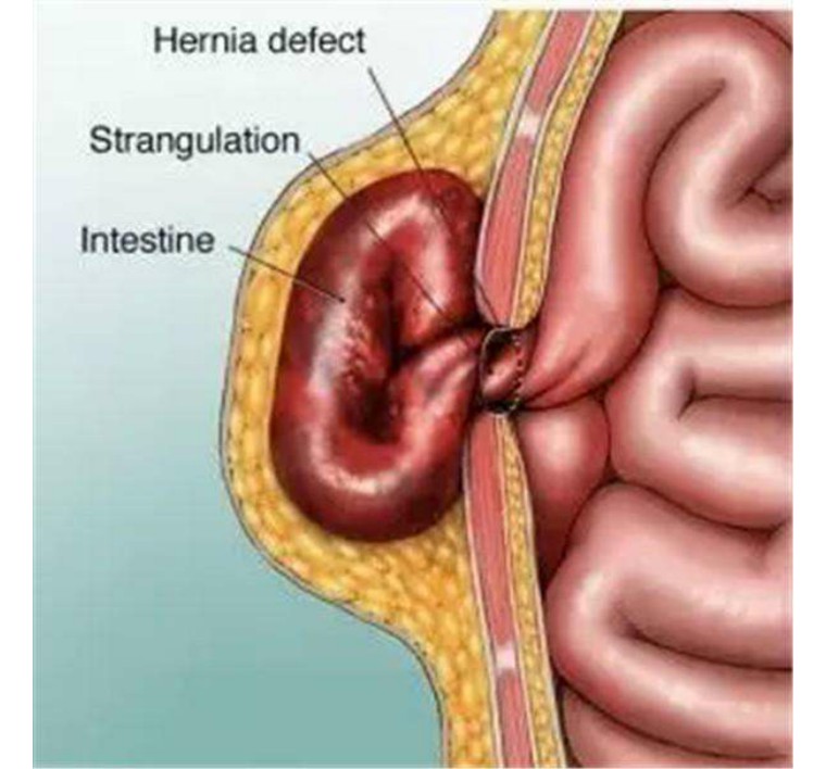 宝宝腹压,为什么宝宝腹压增高就吐奶呢