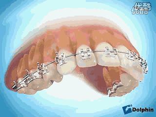 歪瓜裂枣好不好,歪瓜裂枣的牙齿好矫正吗