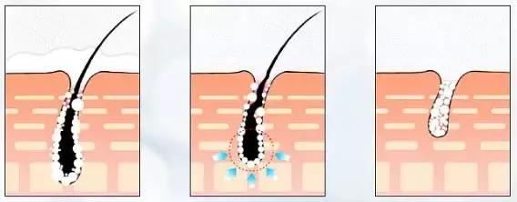 30分钟脱毛神器,最有效最实惠的脱毛神器