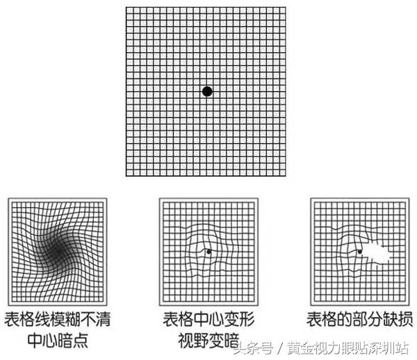 黄斑病变是眼癌吗,致眼盲疾病有哪些