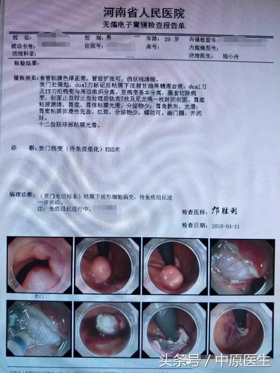“挖窟窿”新进展：内科医生也耍手术刀，在食管开口切肿瘤