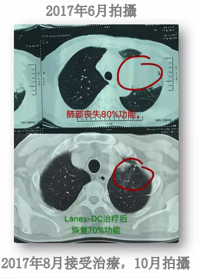 细胞免疫治疗肿瘤什么时间推行的,细胞免疫治疗学