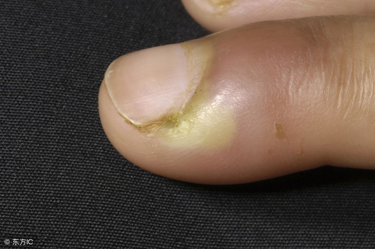 甲沟炎的症状究竟有哪些呢