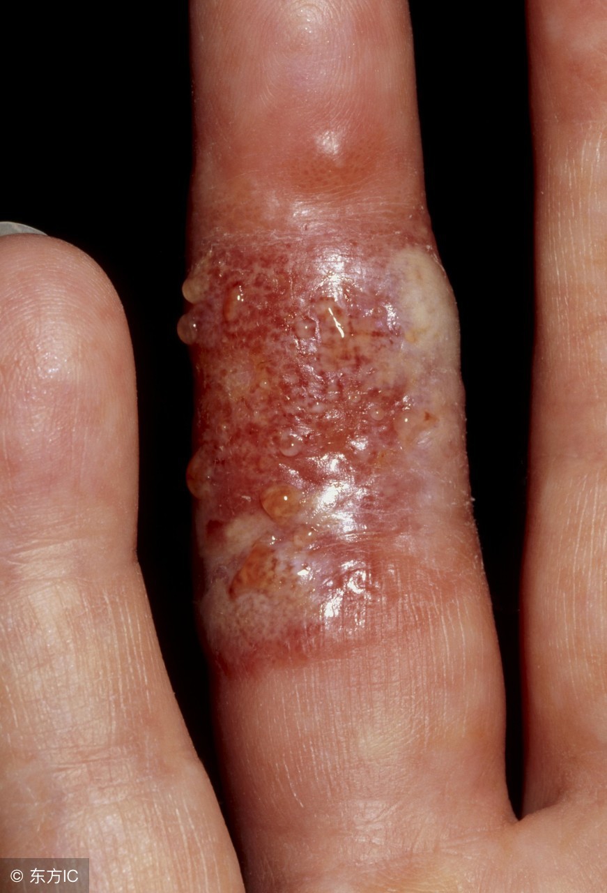 汗疱疹症状轻重的判断,汗疱疹有什么症状呢