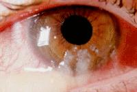 急性结膜炎的治疗心得,急性结膜炎的临床表现及治疗原则