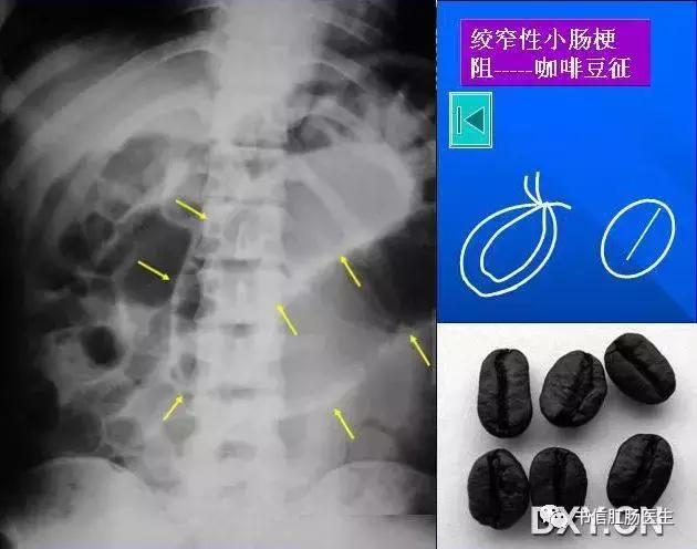10种经典肠道影像征象详解
