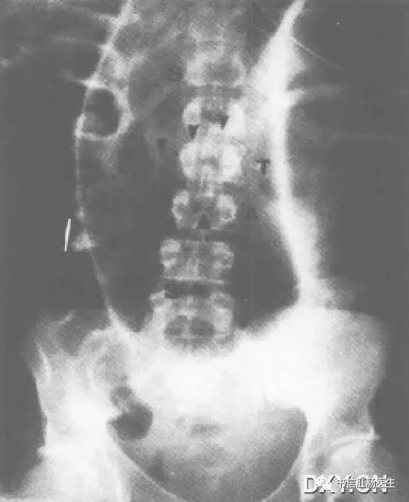10种经典肠道影像征象详解