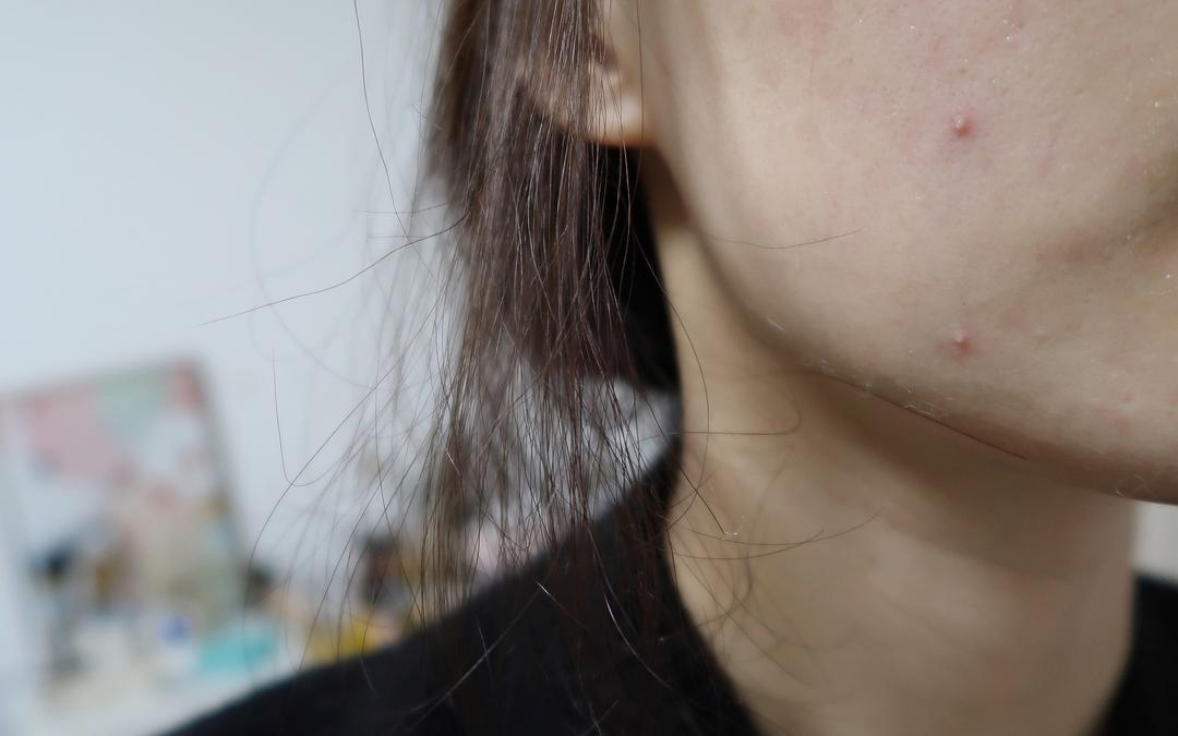 干货|低成本治烂脸攻略:两周见效消闭口淡痘印小经验