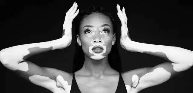 白癜风直播现场,白癜风治疗效果不明显