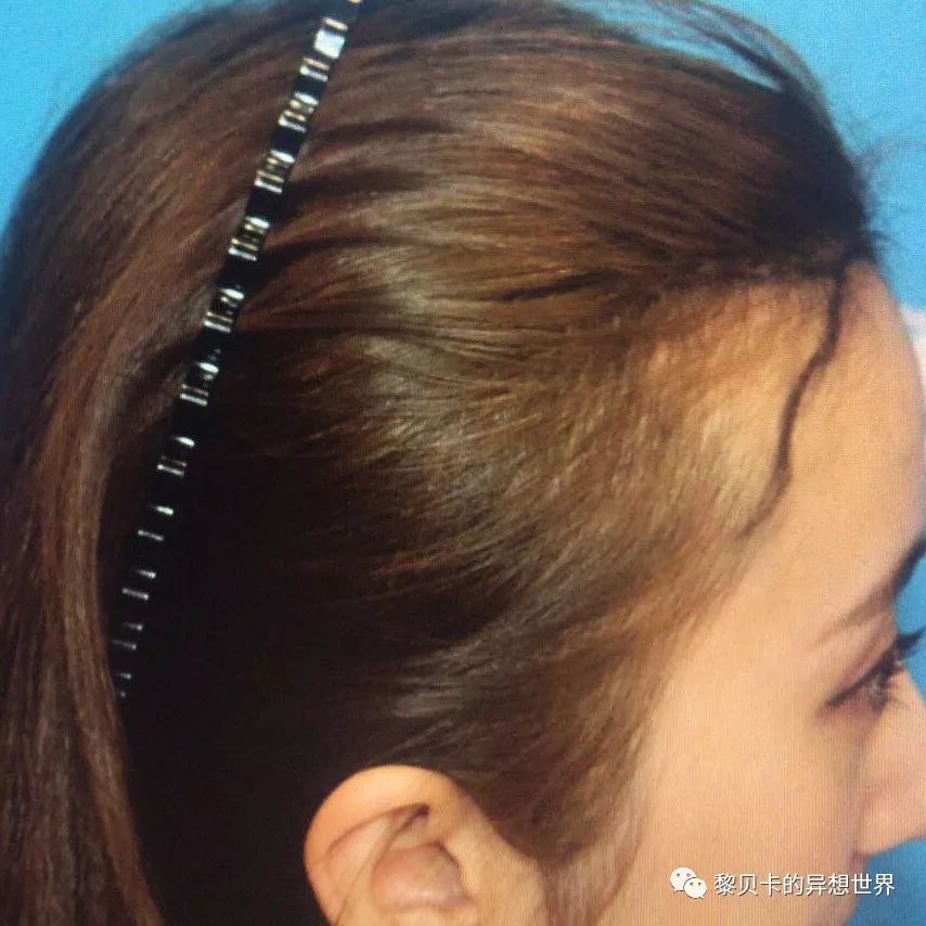 揭秘种植发际线,发际线种植真实体验