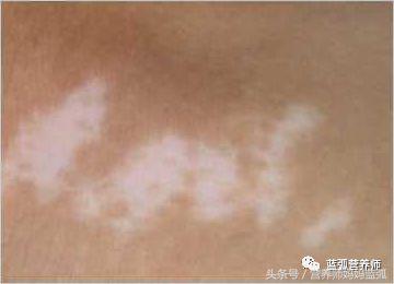 宝宝身上长的白斑是什么病,身上白斑和白癜风的区别