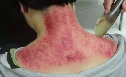 只需早一贴晚一揭即可祛风散寒,每天一贴祛湿效果好