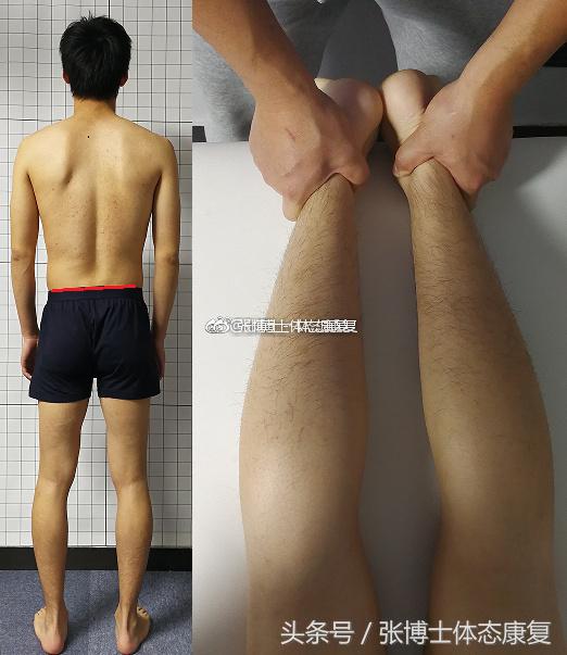 矫正长短腿去哪里矫正,体态矫正腿