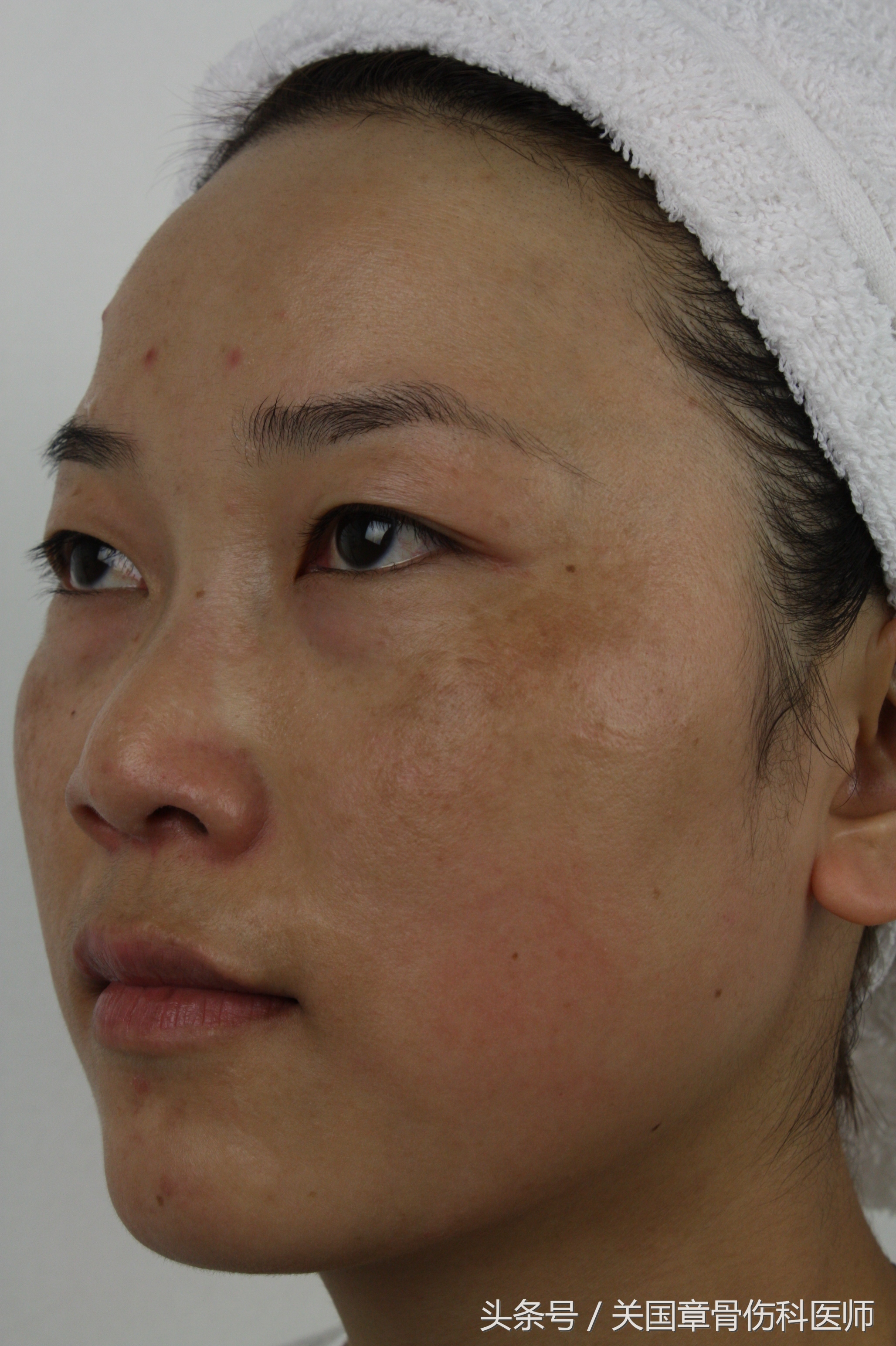 维生素e怎么用祛斑祛痘印,维生素e可以祛斑祛痘吗