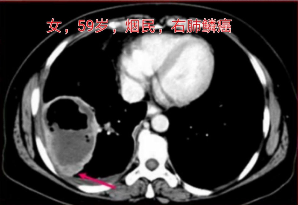 吸烟有害为什么有人能活到90多岁,为什么有的人吸烟寿命更长