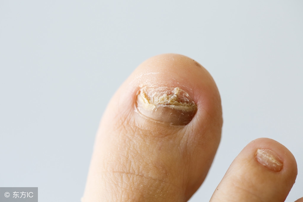 严重的灰指甲的危害到底有多大,灰指甲有没有致命危险